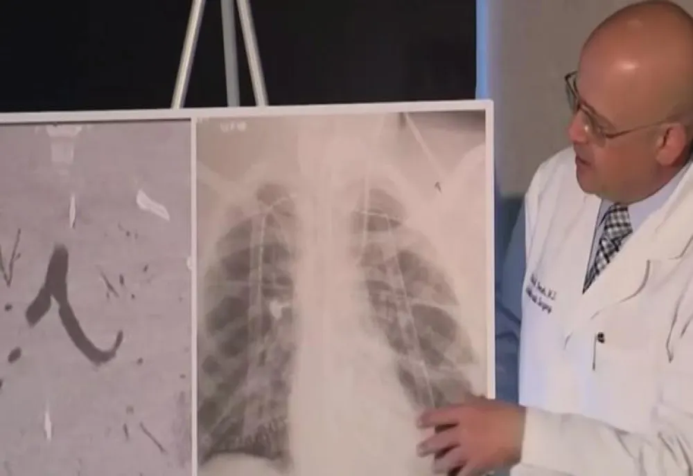 Un adolescent credea că are pneumonie, însă a avut nevoie de dublu transplant de plămâni. Medic: Nu am mai văzut așa ceva